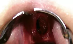 डबल एनल फिस्टिङ, प्र ...